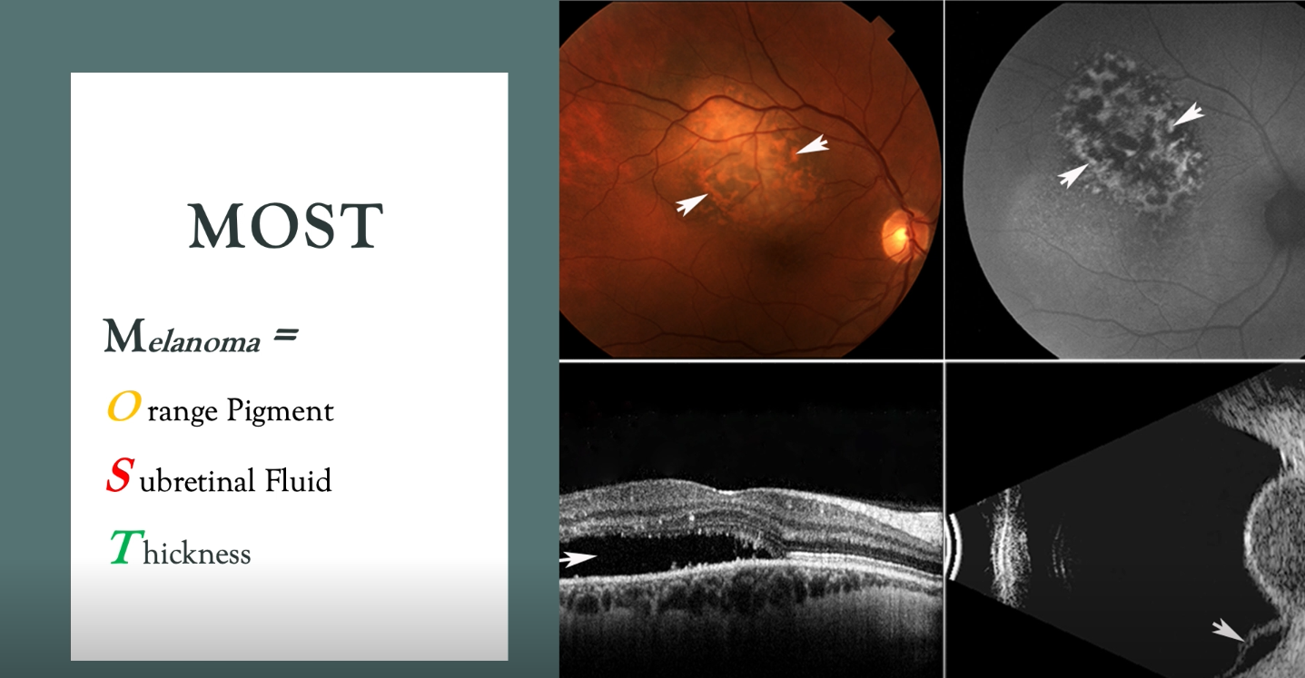 diagnosis-of-small-choroidal-melanoma-eyetube